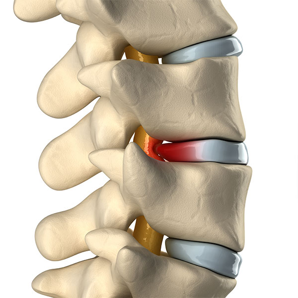 BulgingDisc