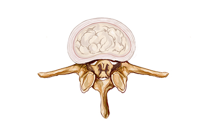 ForaminalStenosis_LP
