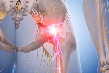 LumbarRadiculopathy_LP