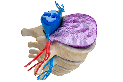 Microdiscectomy_LP