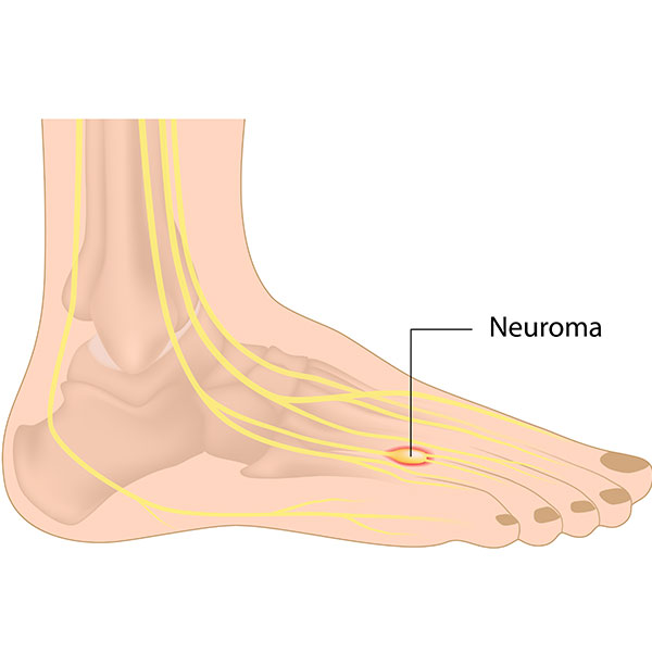 Neuroma