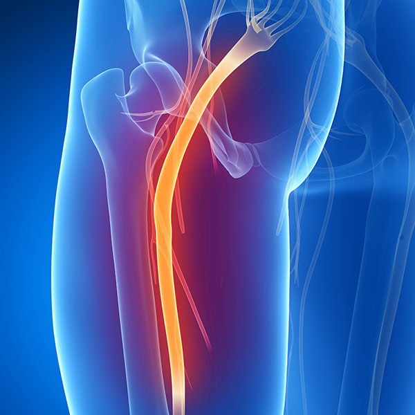 Radiculopathy
