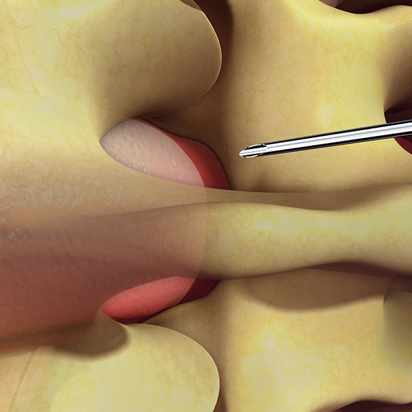 TransforaminalEpiduralInjection